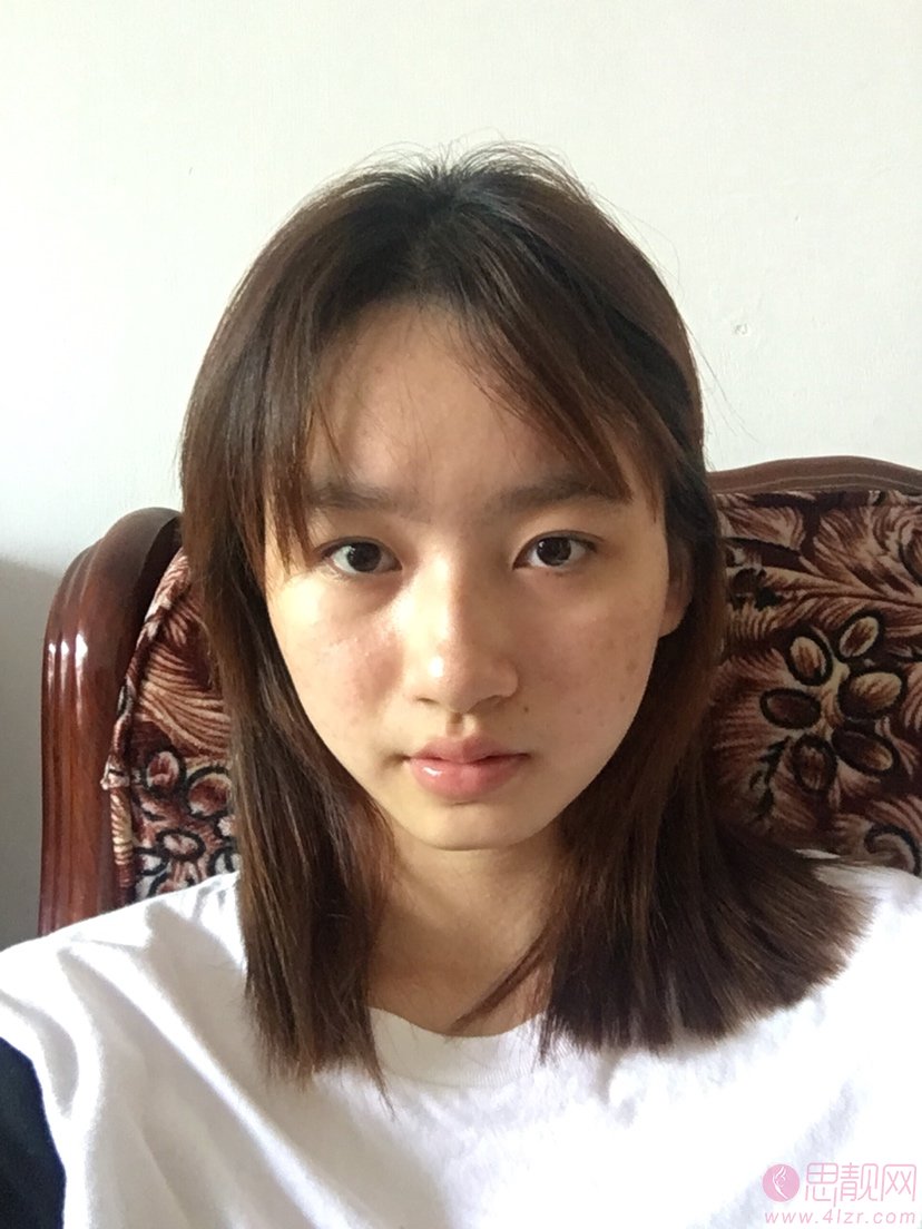 成都天府新区俪颜医疗美容诊所有限责任公司罗小强医生做假体垫眉弓怎么样？2020价格表曝光