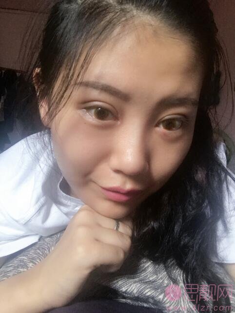 成都天使之翼医学美容医院做双眼皮怎么样？2020价格表一览+双眼皮真人案例分享