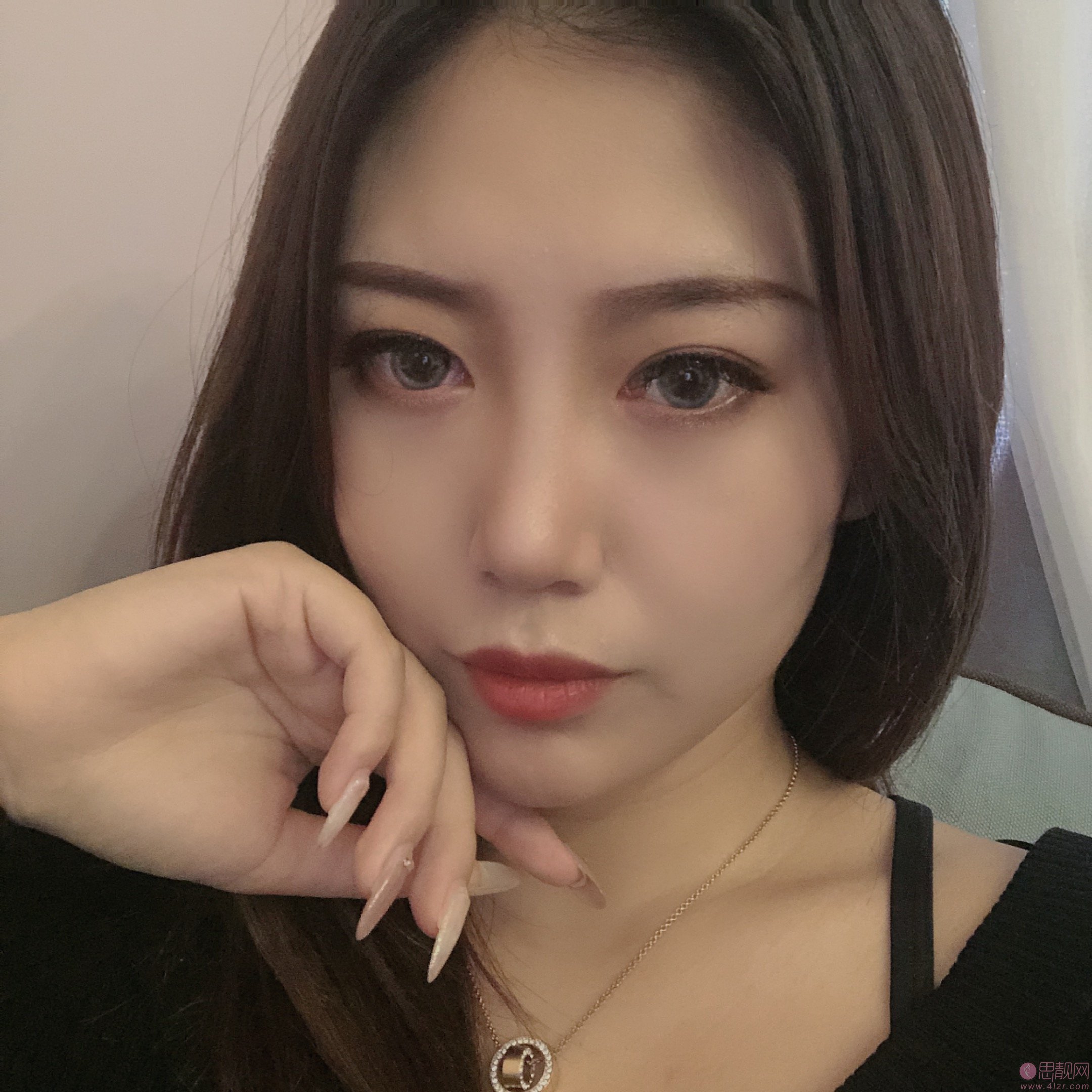 成都天使之翼医学美容医院做双眼皮怎么样？2020价格表一览+双眼皮真人案例分享