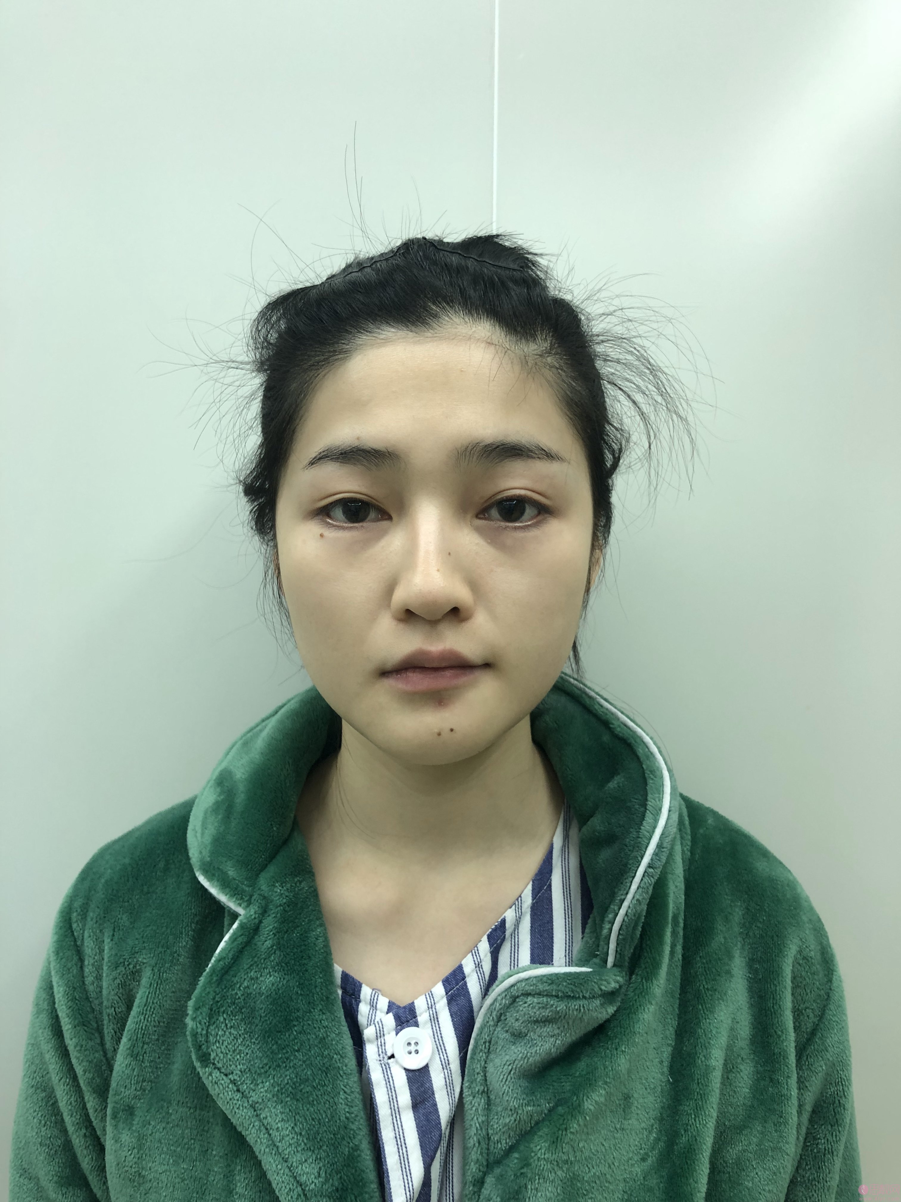 成都维度医疗美容周维医生做隆鼻手术好不好？2020价格表出炉+隆鼻真人术后分享