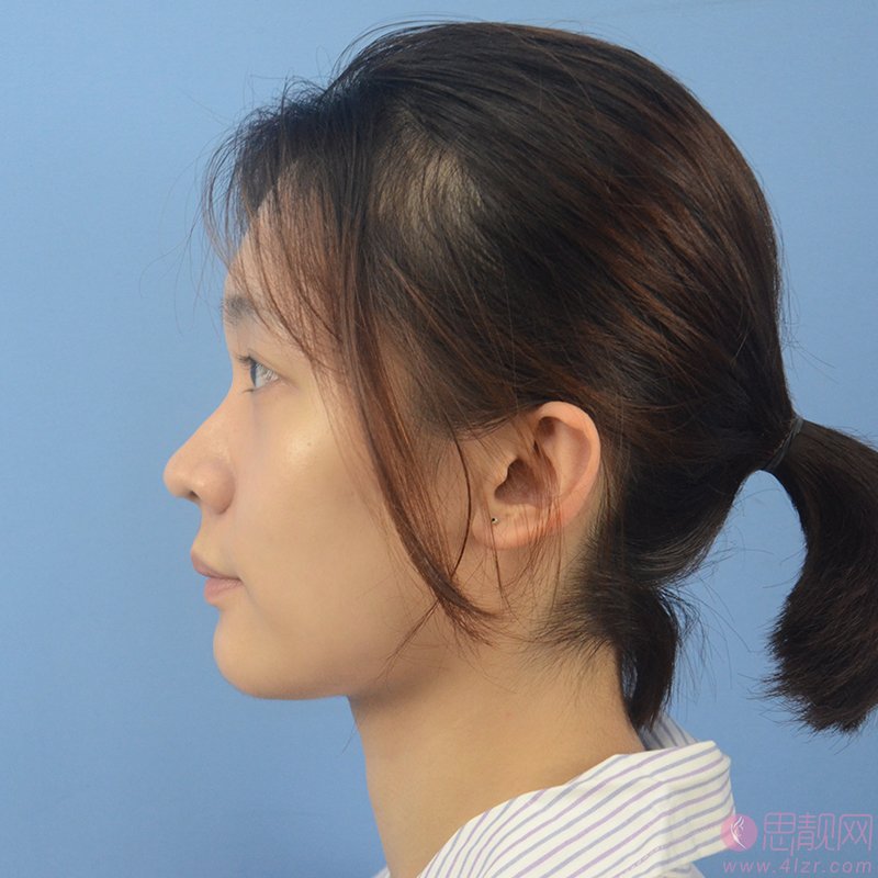 成都华颜医学美容医院隆鼻怎么样？2020价格表曝光隆鼻真人分享