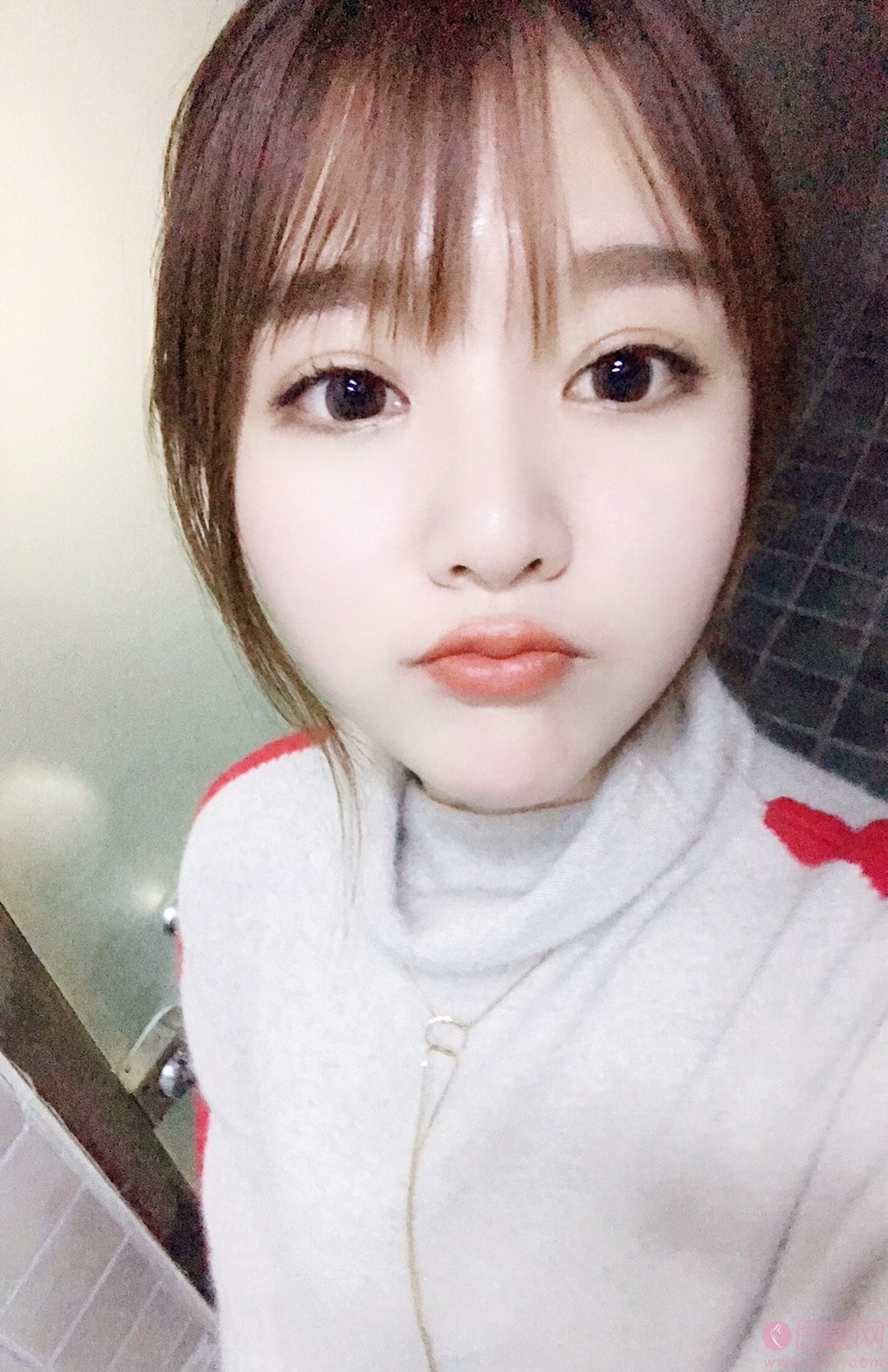 东莞华美医疗美容詹慧医生做双眼皮怎么样？2020价格表曝光+双眼皮真人案例分享
