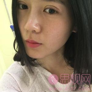 武汉伊美馨医疗美容黄蕾医生做双眼皮如何？2020价格表上线+双眼皮术后真人反馈案例