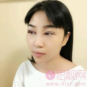 武汉美都医疗美容门诊部做双眼皮手术怎么样?2020价格表出炉+双眼皮术后真人反馈案例