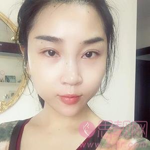 武汉美都医疗美容门诊部做双眼皮手术怎么样?2020价格表出炉+双眼皮术后真人反馈案例