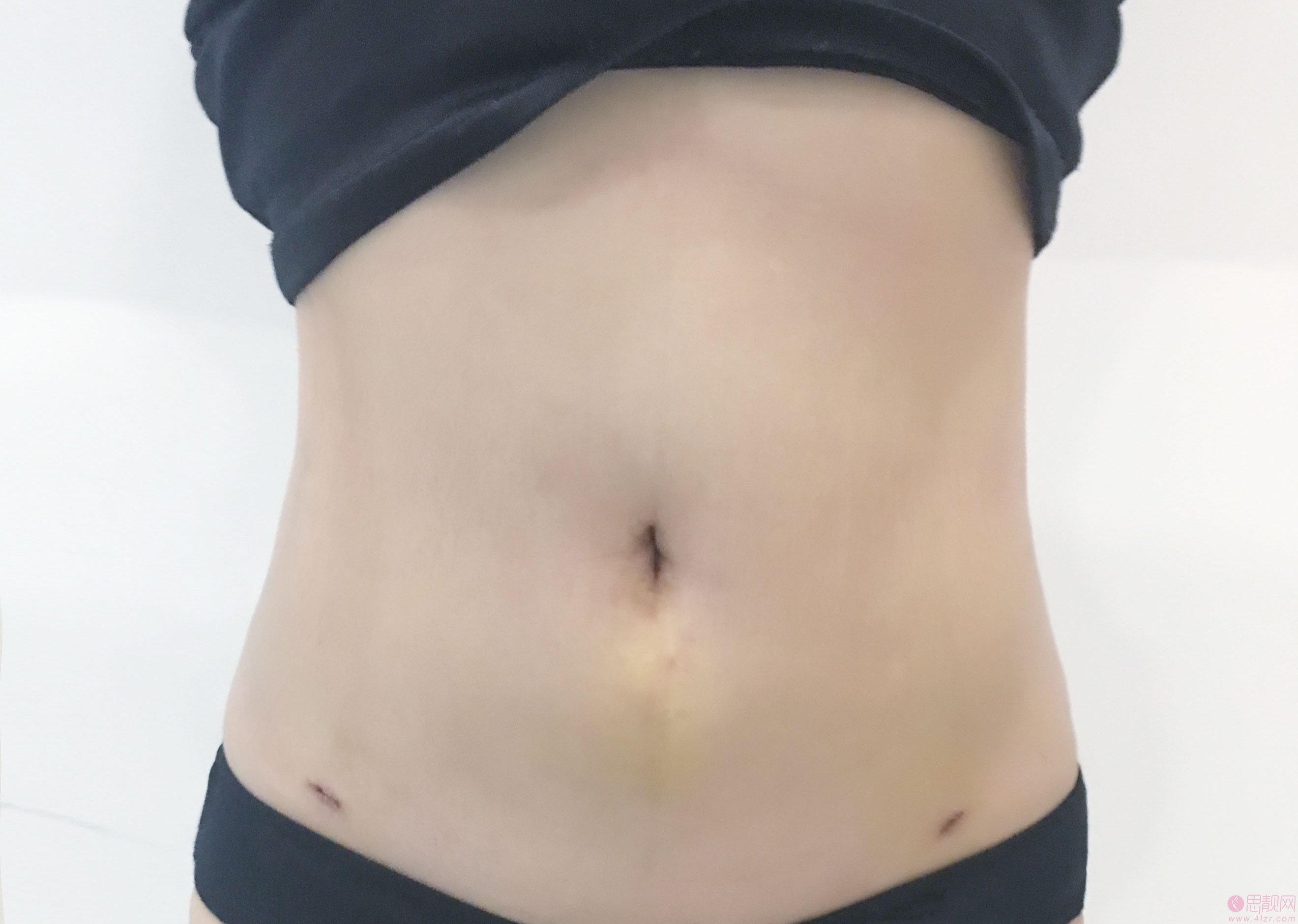 杭州丽脂医疗美容曹飞超做吸脂瘦腰腹怎么样？2020价格表曝光+吸脂瘦腰腹真人案例分享