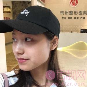 杭州整形医院唐冬生医生做下颌角手术怎么样？2020价格表一览+下颌角术后真人反馈效果