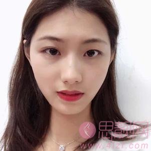 杭州整形医院唐冬生医生做下颌角手术怎么样？2020价格表一览+下颌角术后真人反馈效果