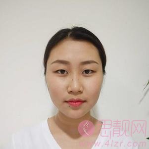 云南华美美莱美容医院做双眼皮手术好不好？附双眼皮真人案例分享及2020价格表一览