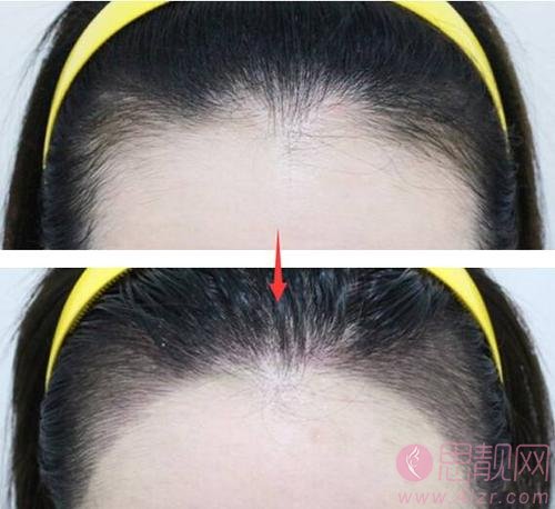 种植发际线是永久的吗？