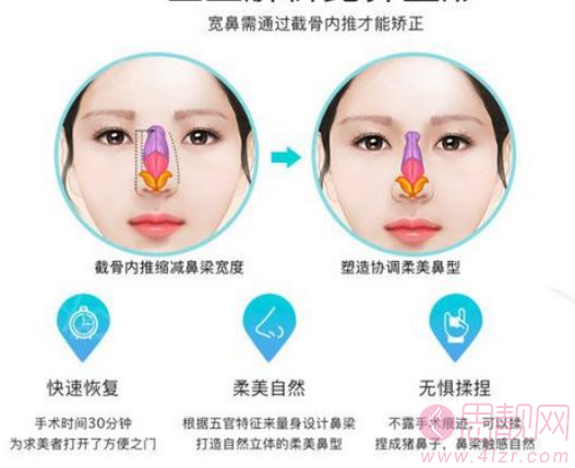 科普|常见几种鼻畸形的矫正方法？