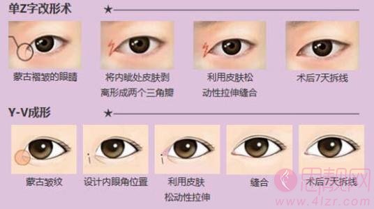 开内眼角与外眼角有什么区别？ 