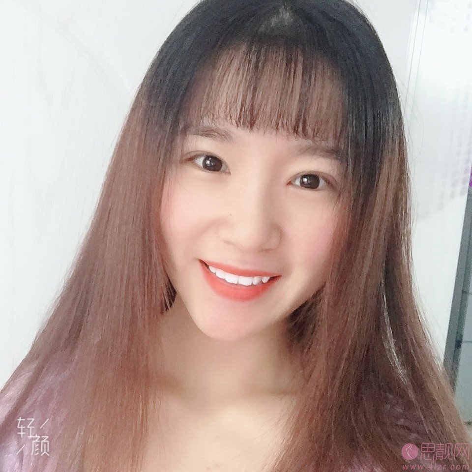 TL: 丽尚整形网温馨提示：任何整形手术都存在一定的风险术前一定要多了解选择正规医院进行手术，想了解更多整形医院，整形案例，整形价格，优惠活动等详细信息都可以点击【在线咨询】与整形顾问进行一对一沟通了解，免费帮你提供医院，医生，价格，等服务对比