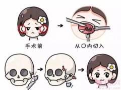 颧骨内推有哪些风险或后遗症?
