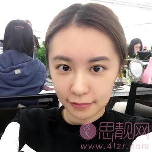 北京悦丽汇医疗美容-三里屯店姚然医生硅胶垫下巴好不好？2020价格表曝光+硅胶垫下巴术后效果反馈