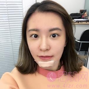 北京悦丽汇医疗美容-三里屯店姚然医生硅胶垫下巴好不好？2020价格表曝光+硅胶垫下巴术后效果反馈