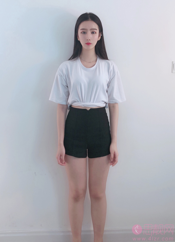 华生医美医疗美容王亚璐医生吸脂怎么样？2020价格表上线+吸脂真人案例反馈