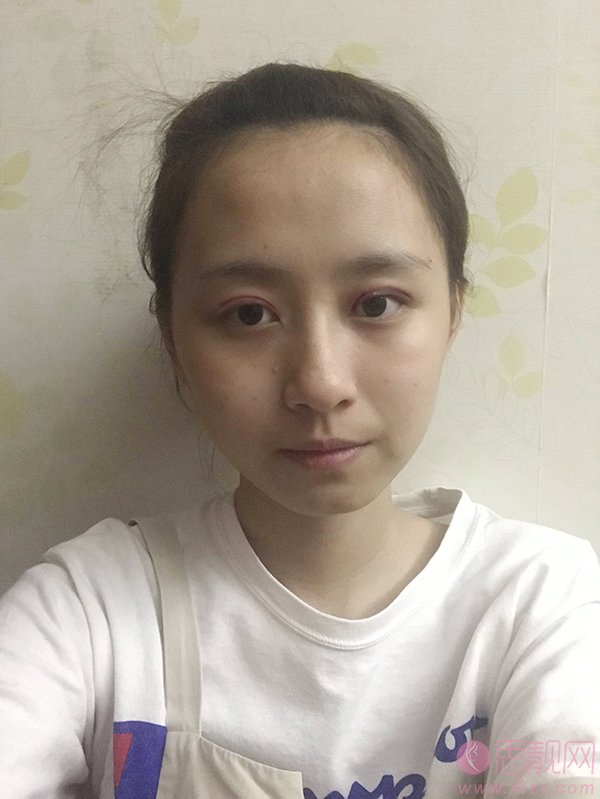 西安壹加壹医疗美容医院（西北旗舰店）李建辉医生做双眼皮怎么样？2020价格表一览