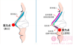 鼻修复需要注意哪些事项？