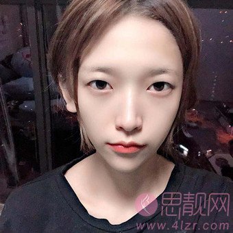 西京医院孙峰医生做双眼皮好不好？附双眼皮真人案例一览+2020价格表曝光