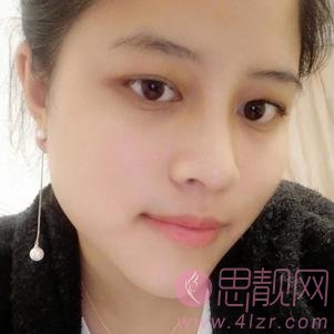 四川省人民医院整形外科隆鼻怎么样?附隆鼻真人案例一览及2020价格一览