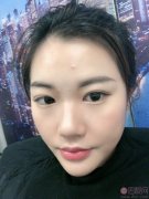 南京华韩奇致美容医院（旗舰店）肋软骨隆鼻怎么样？2020价格表上线+隆鼻术后