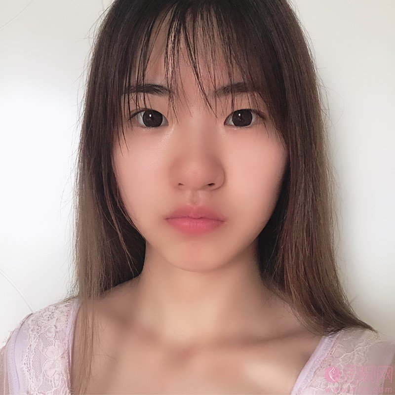 中山一院整形外科医生哪个割双眼皮比较好?附双眼皮真人案例一览及2020价格表曝光