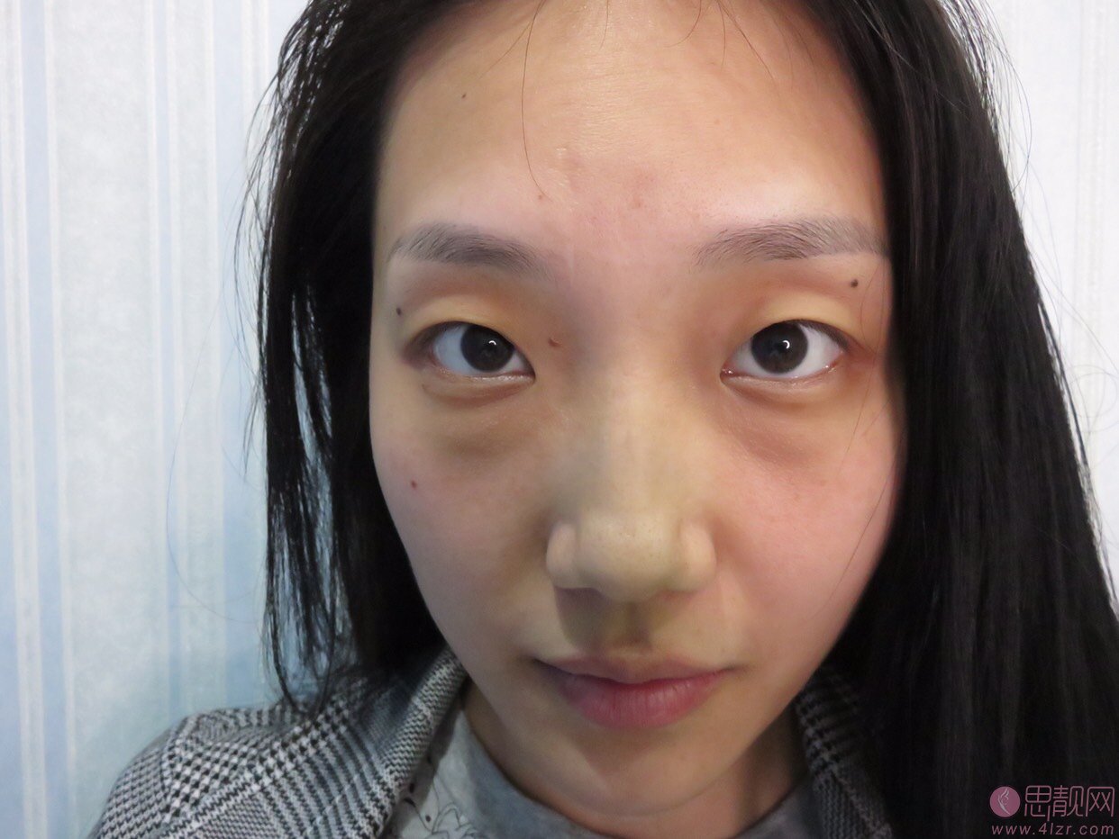 重庆超雅医疗美容整形激光祛眼袋怎么样?2020价格表一览+祛眼袋真人反馈