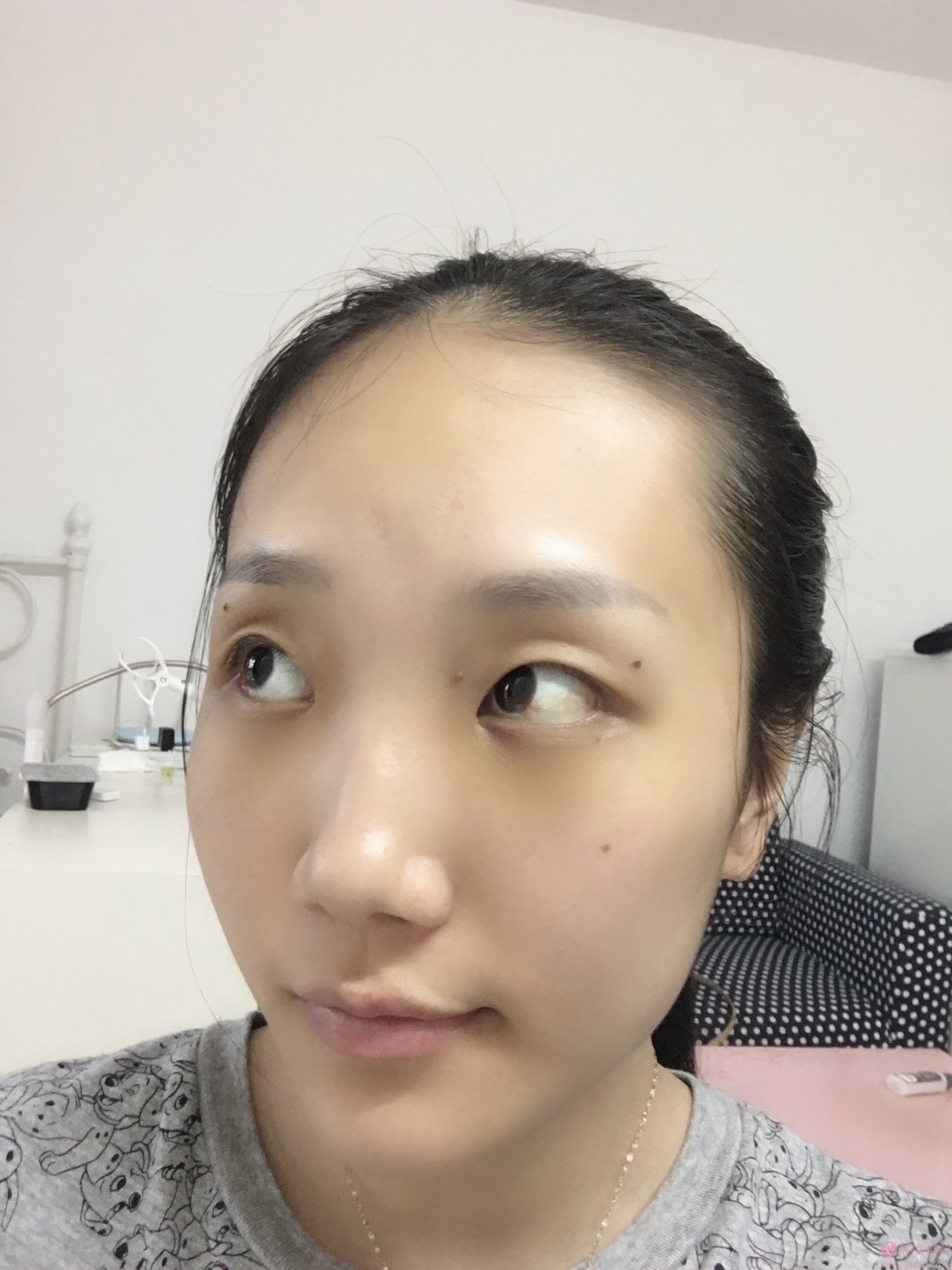 重庆超雅医疗美容整形激光祛眼袋怎么样?2020价格表一览+祛眼袋真人反馈