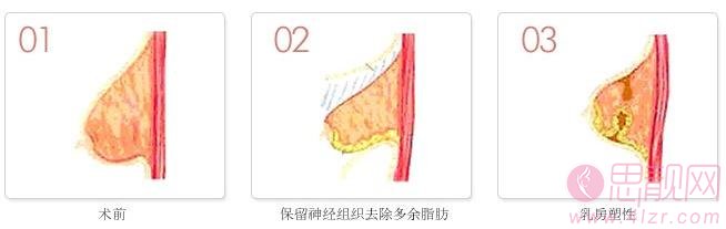乳晕缩小方法 