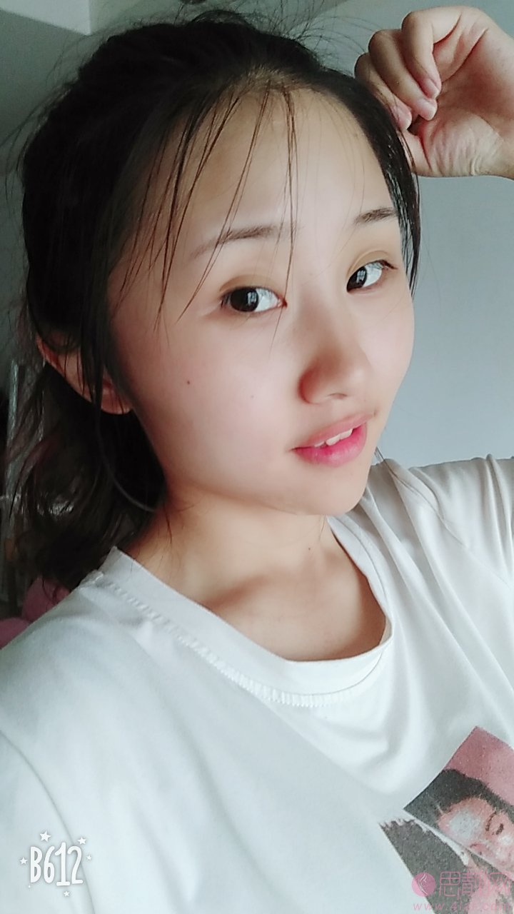 徐州医科大学附属医院做隆鼻手术怎么样？2020价格表上线+隆鼻真人案例术后分享