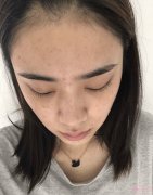 成都润禾皮肤病专科医院做点阵激光怎么样？2020价格表曝光