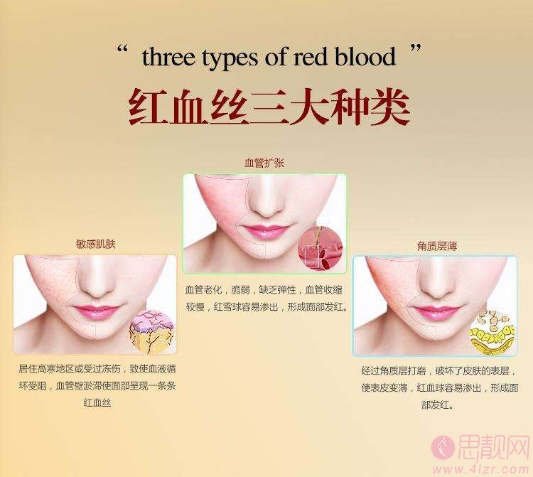 激光祛红血丝好不好？有哪些优势和劣势？ 