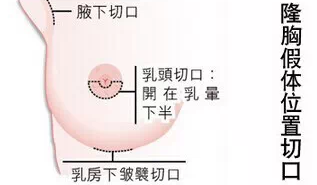 隆胸对哺乳有影响吗？