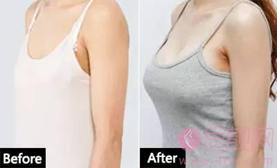 隆胸对哺乳有影响吗？