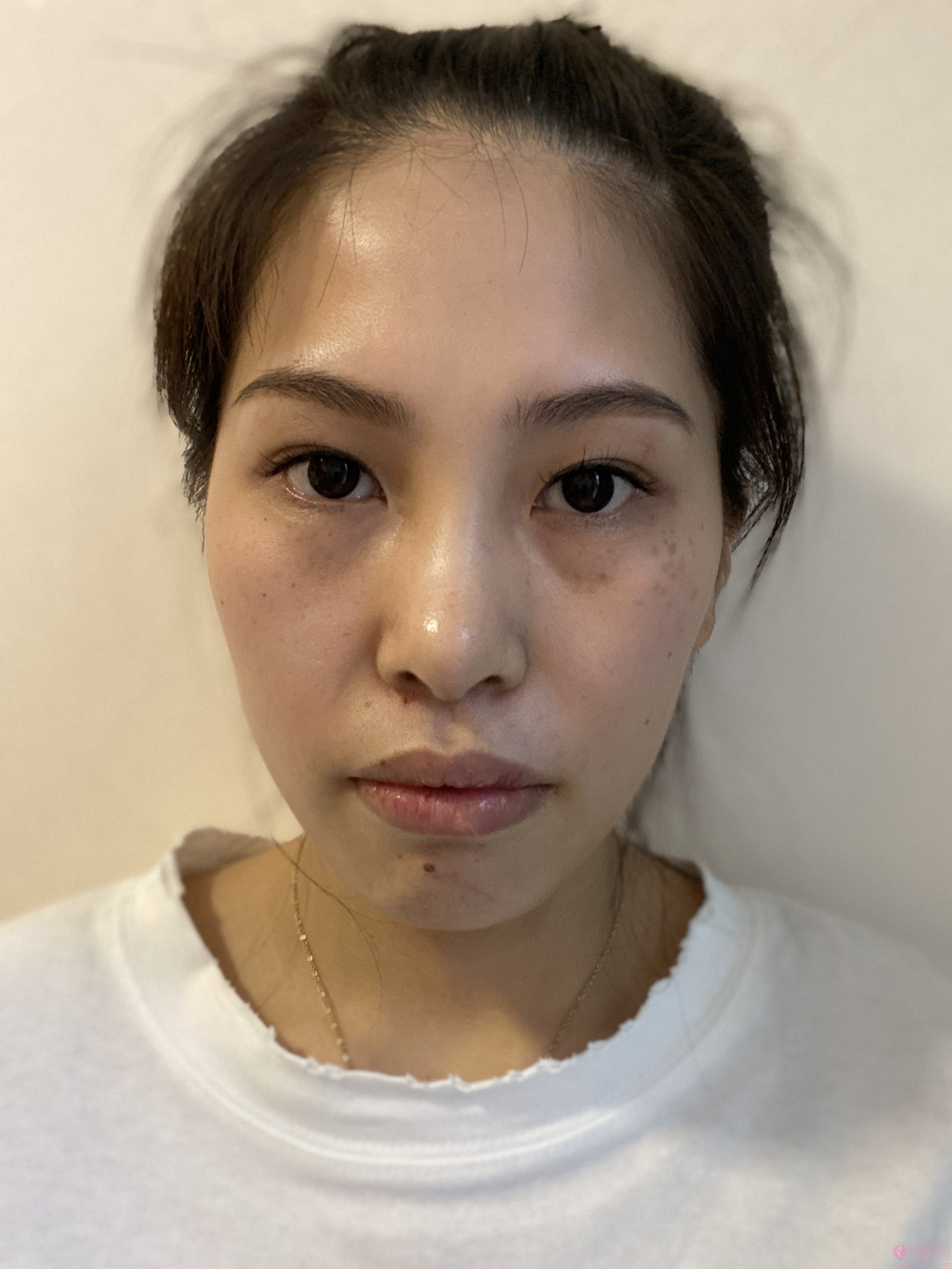 北京卓彦丽格医疗美容诊所卢宏医生做皮秒激光怎么样？2020价格表曝光