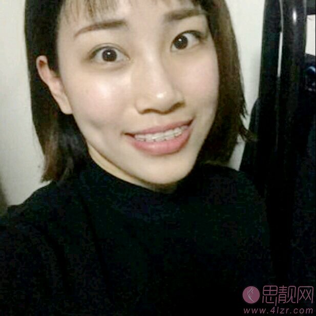 天津市中诺口腔医院隐形矫正怎么样?2020价格表曝光+隐形矫正真人案例分享