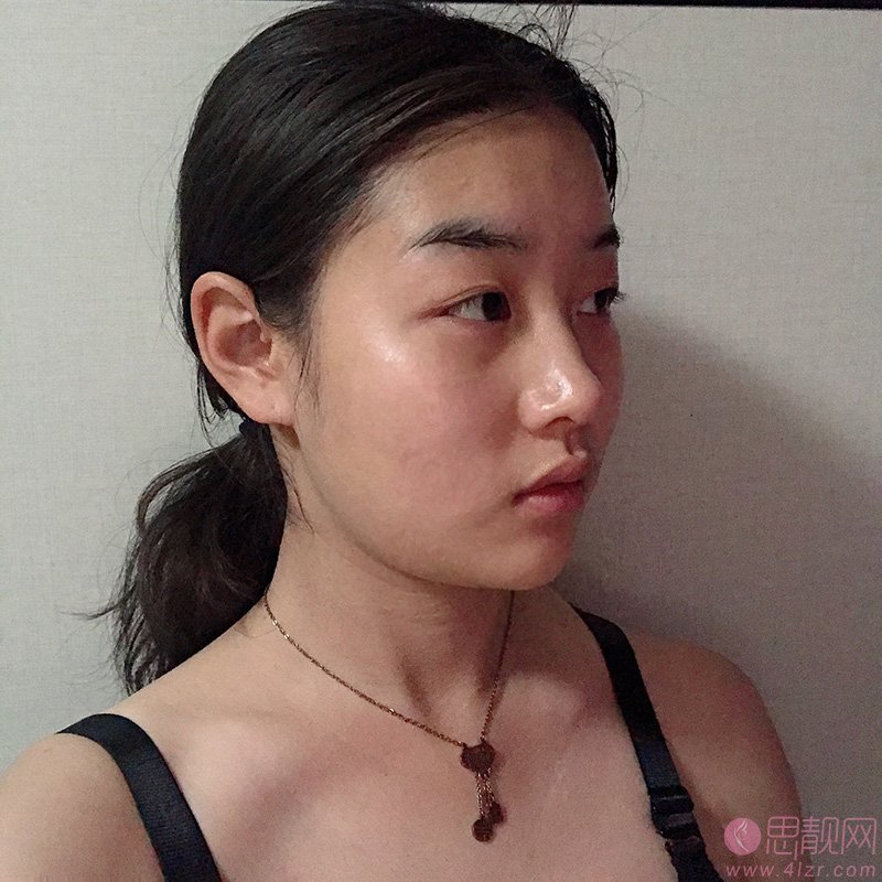 太原美媛荟整形美容医院冯宇医生做埋线提升怎么样？附埋线提升案例分享及2020价格表出炉