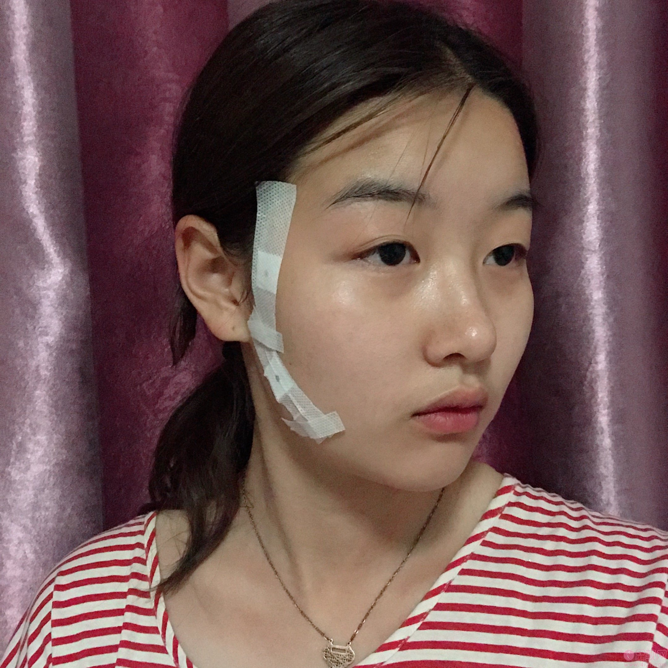 太原美媛荟整形美容医院冯宇医生做埋线提升怎么样？附埋线提升案例分享及2020价格表出炉