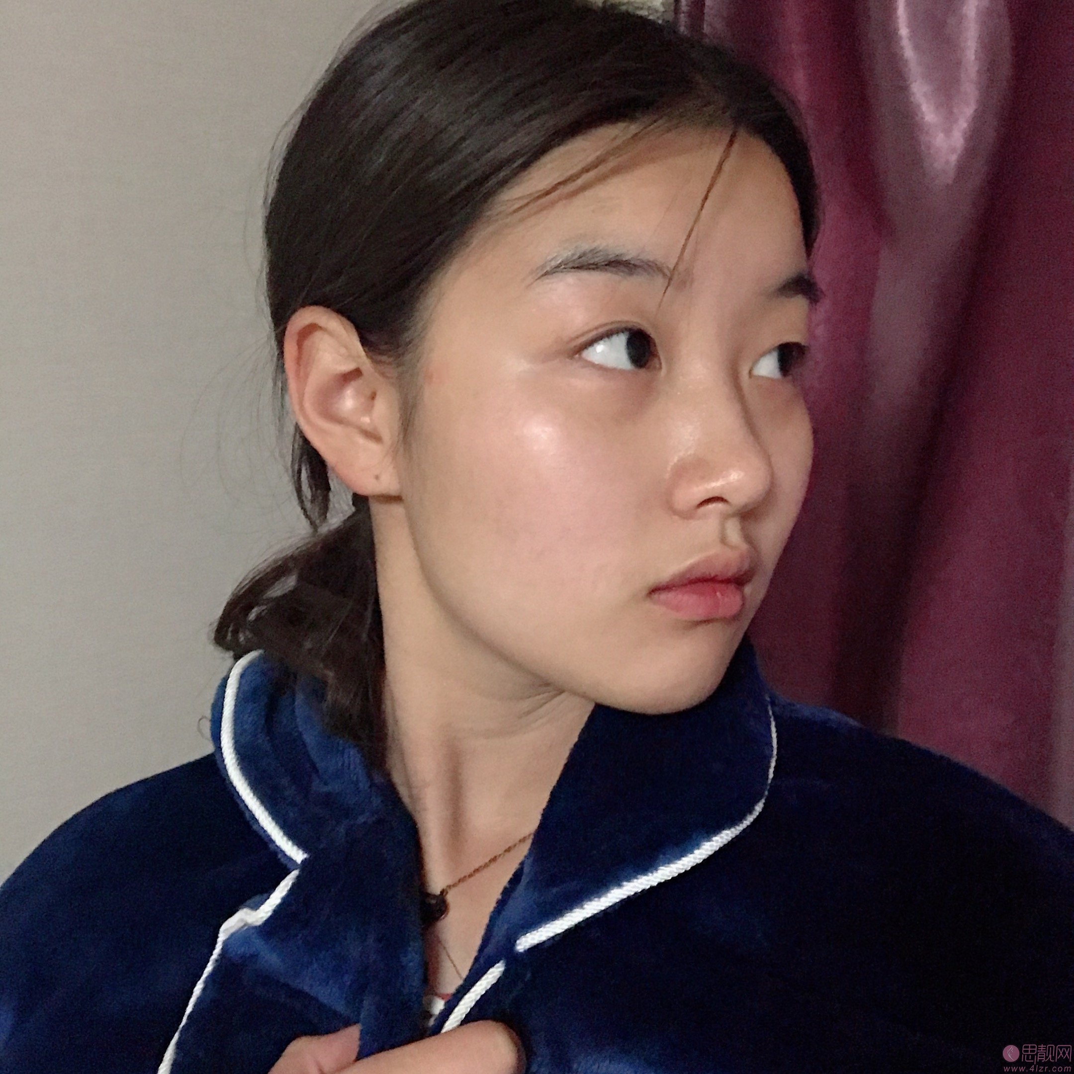 太原美媛荟整形美容医院冯宇医生做埋线提升怎么样？附埋线提升案例分享及2020价格表出炉