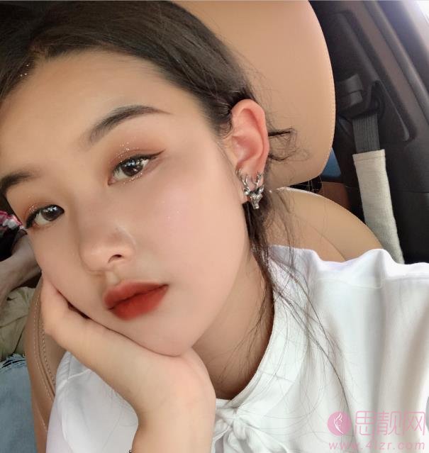 太原美媛荟整形美容医院冯宇医生做埋线提升怎么样？附埋线提升案例分享及2020价格表出炉