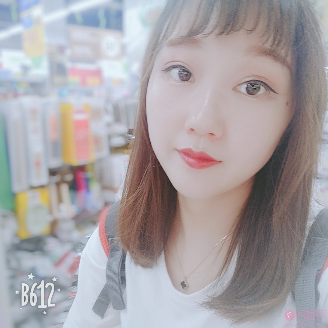 合肥华美整形外科医院2020价格表公开+、双眼皮术后真人案例一览