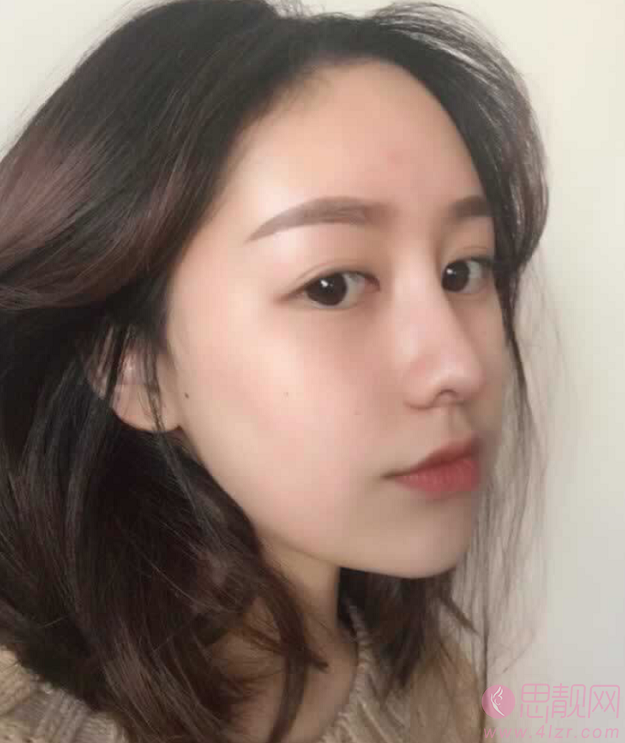 青岛诺德医学美容医院2020价格表一览+隆鼻术后分享