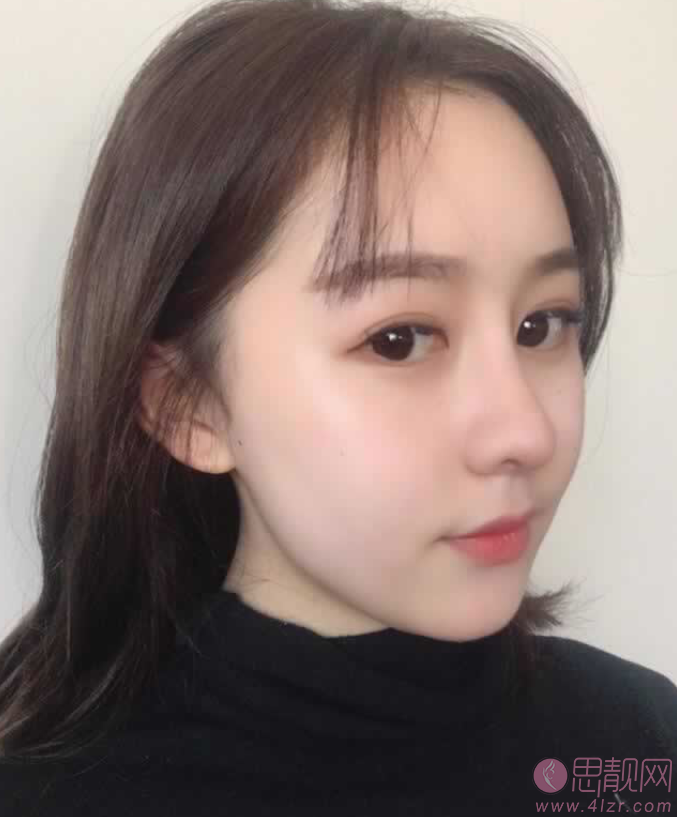 青岛诺德医学美容医院2020价格表一览+隆鼻术后分享