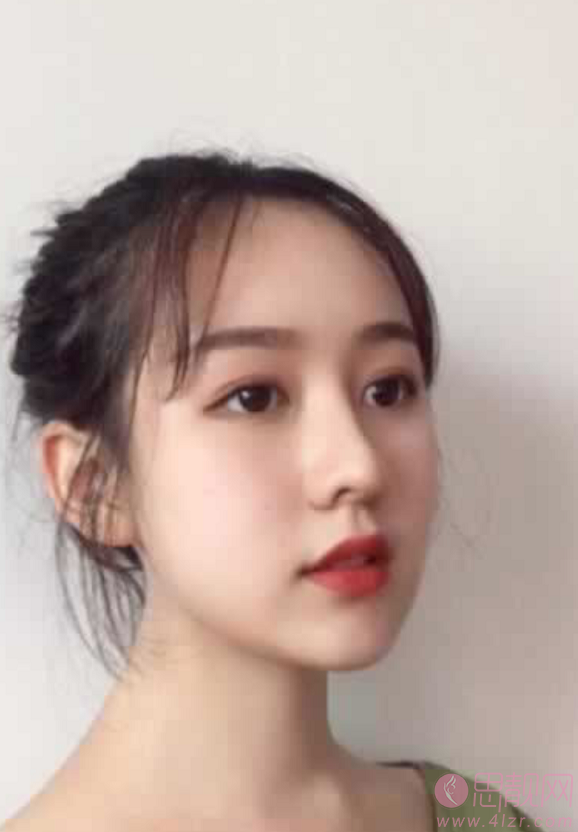 青岛诺德医学美容医院2020价格表一览+隆鼻术后分享