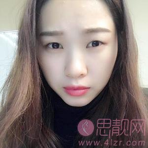 郑州美莱医疗美容医院张芳做双眼皮手术怎么样?2020价格表发布