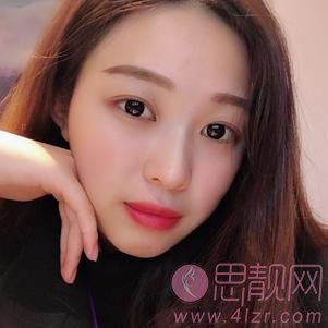 郑州美莱医疗美容医院张芳做双眼皮手术怎么样?2020价格表发布