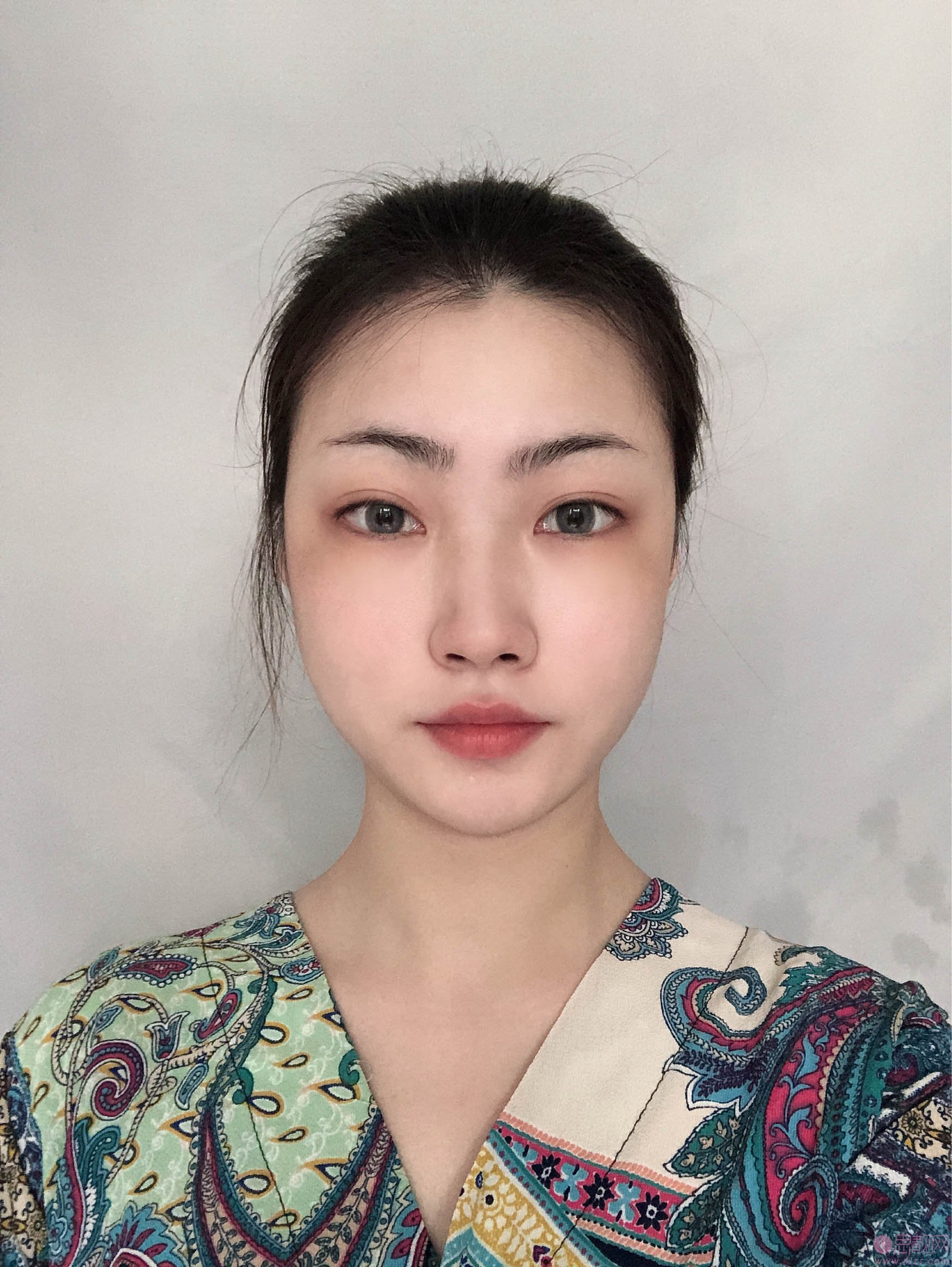 温州和平整形医院梁赞姜隆鼻好不好？2020价格表一览+隆鼻术后真人案例分享