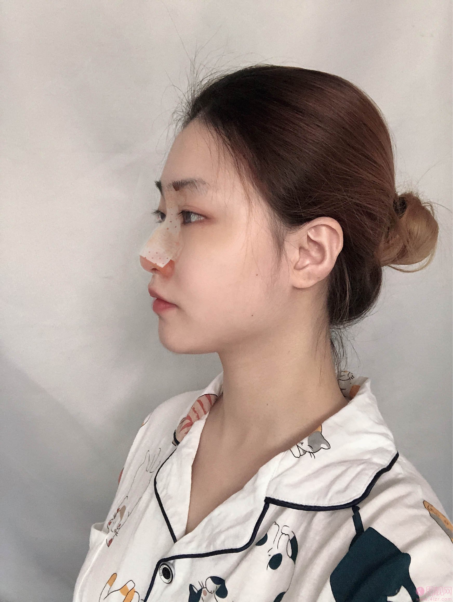 温州和平整形医院梁赞姜隆鼻好不好？2020价格表一览+隆鼻术后真人案例分享