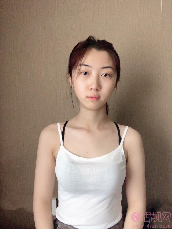 重庆艺星医疗美容医院朱家旭隆鼻好不好？2020价格表一览+隆鼻术后案例一览